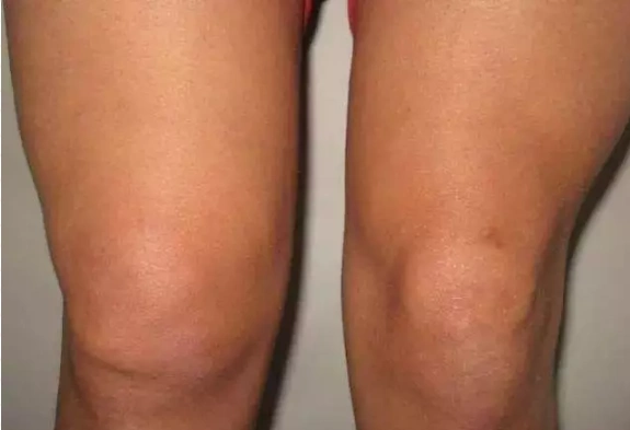 北京西京中医医院肌肉萎缩患者平时应吃些什么