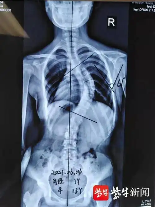 13岁少女肩膀一高一低!专家:当心青少年脊柱侧弯